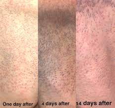 But the average results you can expect is for 70% to 80% of hair regrowth reduction after a full four to six courses of treatments. Hair Removal Results From One Session Of Laser Hair Removal Skincareaddiction