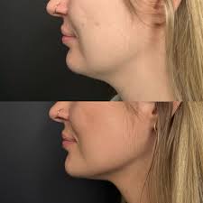 Buckle up, this is a long one. However, if you're considering booking in  for a CO2 laser treatment, it's worth listening in so you know what your  healing journey may look like (