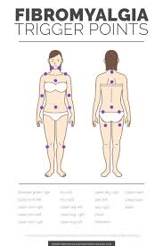 Fibromyalgia Tender Points Trigger Points Fibromyalgia Fibromyalgia Trigger Points Chronic Fatigue Syndrome