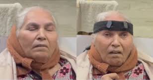 Pateint with Apraxia of eyelid opening (left), eyes are open while...