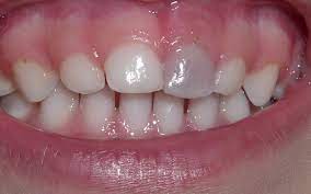 Faq Color Changes In Teeth Discovery Pediatric Dentistry