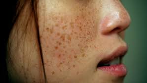 Air mawar dapat mengurangi peradangan dan inflamasi pada kulit serta memudarkan kantung hitam di sekitar mata. Buang Bintik Hitam Di Muka Dengan Cara Paling Berkesan Story Of Health Beauty