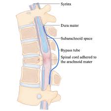 Image result for Syringomyelia
