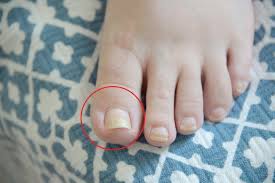 Aceite de árbol de té puede ayudar a deshacerse de los hongos en las uñas de los pies que causa engrosadas y las uñas. Con Este Aceite Eliminas Los Hongos De Las Unas De Volada