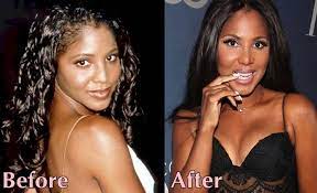 Toni reveal that she has had a lip suction on her thighs to reduce the weight of her tights and to make them thinner than of the thick that looks odd. Toni Braxton Plastic Surgery With Before And After Photos