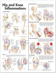 Hip And Knee Inflammations Anatomical Chart
