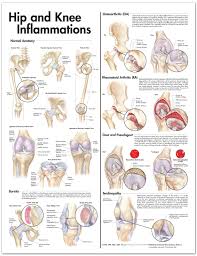 hip and knee inflammations anatomical chart