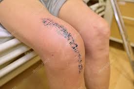 Faster and less painful rehabilitation. Knee Joint Replacement Is A Surgical Procedure That Involves Removing Very Painful Knee Joint Affected By Accident Or Arthritis Patient On The Bed In Hospital 185281590 Larastock