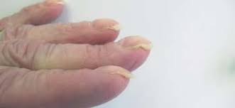 Image result for Akutní zánět nehtového lůžka