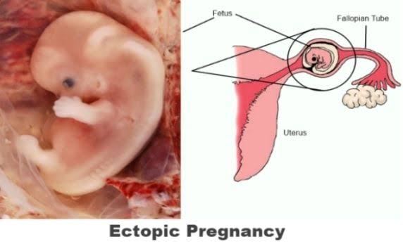 Mga resulta ng larawan para sa Ectopic pregnancy, fetus growing in the fallopian tube"