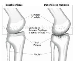 The Different Types Of Knee Pain In Menopausal And Post Menopausal Women And Non Surgical Treatment Options Caring Medical Florida