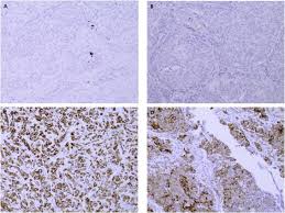 Mesothelioma, also known as malignant mesothelioma, is an aggressive malignant tumor of the mesothelium. Ntrk And Alk Rearrangements In Malignant Pleural Mesothelioma Pulmonary Neuroendocrine Tumours And Non Small Cell Lung Cancer Lung Cancer