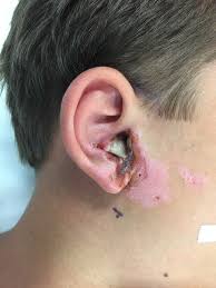 Image result for Necrotizing Otitis Externa
