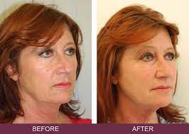 Thread lift before and after uk. Silhouette Soft Thread Lifts Non Surgical Face Lift Skin Excellence Clinics