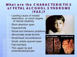 Pin On Fetal Alcohol Syndrome