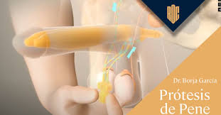 Image result for Penile Prosthesis