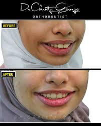 This young girl came to us worried about her smile — she felt her  protruding teeth gave her a “bunny-like” appearance. To which we replied  “Say no more... we got you😄!” Swipe