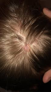 De varierer i størrelse, men mange er relativt store og verker. Hva Er Denne Klumpen I Hodebunnen Bilde Kropp Og Helse Kvinneguiden Forum