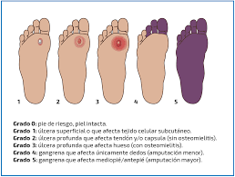 Infecciones en el pie diabético | FONDOSCIENCE