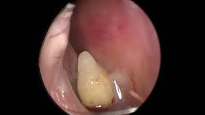 Check spelling or type a new query. Tooth Growing Inside Nose Causes Nasal Congestion Youtube