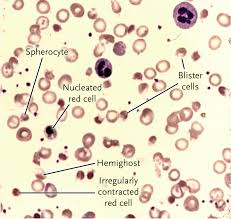 Image result for G6PD Deficiency