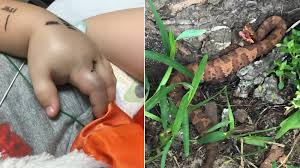 Image result for Snake Bite