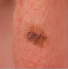 It is always best to check with your doctor as soon as possible if you're concerned about any spot or growth on your skin. Melanoma At Its Most Curable The Skin Cancer Foundation