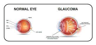 Glaucoma is a group of eye diseases that can cause vision loss and blindness by damaging a nerve in the back of your eye called the optic nerve. Definition Of Glaucoma Thea