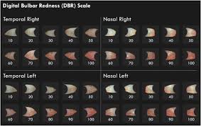 A New Scale For The Assessment Of Conjunctival Bulbar