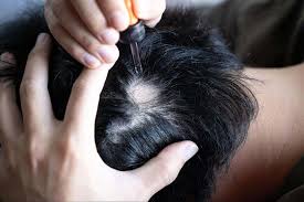 Rụng tóc từng mảng: Nguyên nhân, chẩn đoán và phòng ngừa