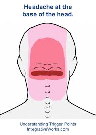 Back Of Head Integrative Works Trigger Points Headache Headache Remedies
