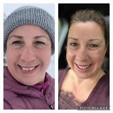 Should I file down my front teeth after Invisalign treatment?