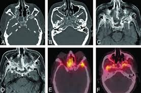 Image result for Osteomyelitis Bone Scan