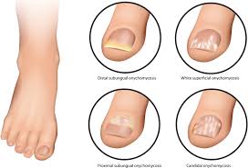 foot infection symptoms treatment