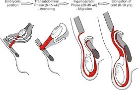 And cryptorchidism on the other side, a thorough investigation is warranted to exclude an underlying dsd such both patients had cryptorchidism and inguinal hernia for which they were operated upon. Cryptorchidism And Hypospadias Endotext Ncbi Bookshelf