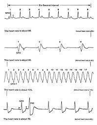 Ekg Interpretation