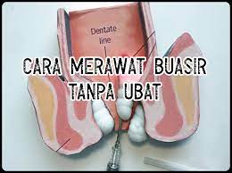 Dengan kata lain, terpaksa tolak ke dalam dengan. Tips Dan Pengalaman Cara Merawat Buasir Luaran Secara Alami Tanpa Ubat