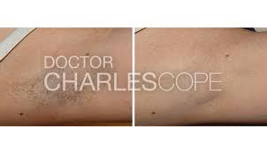 Ultimately, this laser hair removal sydney may outcome in the need to have for much more sittings than needed. Laser Hair Removal Sydney Gosford Dr Charles Cope