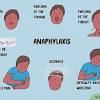 Anaphylaxis usually develops suddenly and gets worse very quickly. 1