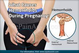 While piles are rough, pokey and unmanageable, let us delve into some important facts about hemorrhoids and the viable measures to tackle them while you are pregnant. What Causes Hemorrhoids During Pregnancy Know Its Prevention And Treatment