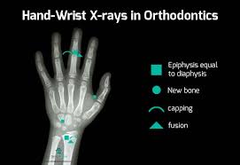 Hand Wrist X Ray Analysis For Orthodontic Treatment Planning