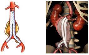 Generali tes cliniques et rnale formes diagnostic. Anevrisme De L Aorte Abdominale Une Prothese Revolutionnaire Au Chu De Toulouse
