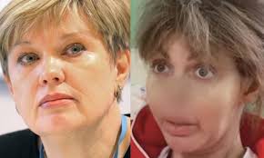 Немного спустя пластической операции у неё. Alisa Arshavina Sejchas Ona Hotela Unichtozhit Menya I Moih Detej Alisa Arshavina Alisa Arshavina Kazmina Perenesla Operaciyu Na Pazuhah Nosa No Nesmotrya Na Sostoyanie Ee Zdorovya Movie Support