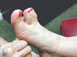 Diagnosing And Treating Cuboid Syndrome In Athletes Podiatry Today Hmp Global