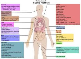 First Trial Of Gene Therapy For Cystic Fibrosis Cystic Fibrosis Symptoms Cystic Fibrosis Awareness Cystic Fibrosis