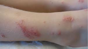 Image result for bedbugs bites