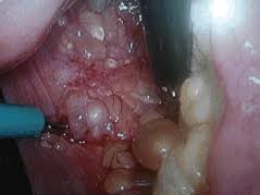 Learn more about ovarian cancer such as what causes it, how it is diagnosed, and available treatment options. Asymptomatic Peritoneal Carcinomatosis Originating From Benign Cystic Peritoneal Mesothelioma Ecancer