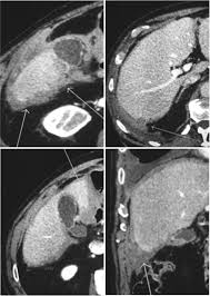If these features do not fit with the diagnosis that is being. Rare Localizations Of Mesothelioma Springerlink