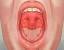 Acid reflux throat lump sensation