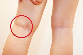 Check spelling or type a new query. Swelling Behind The Knee Causes Treatment